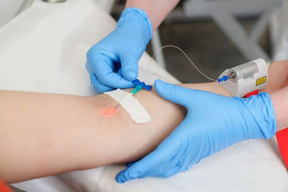 intravénás lézeres kezelés pikkelysömör a lábakon