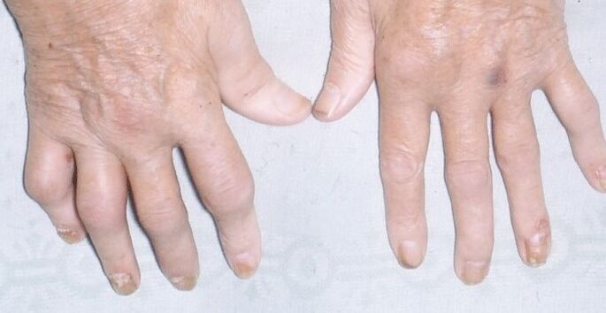 arthropathiás pikkelysömör a kezeken