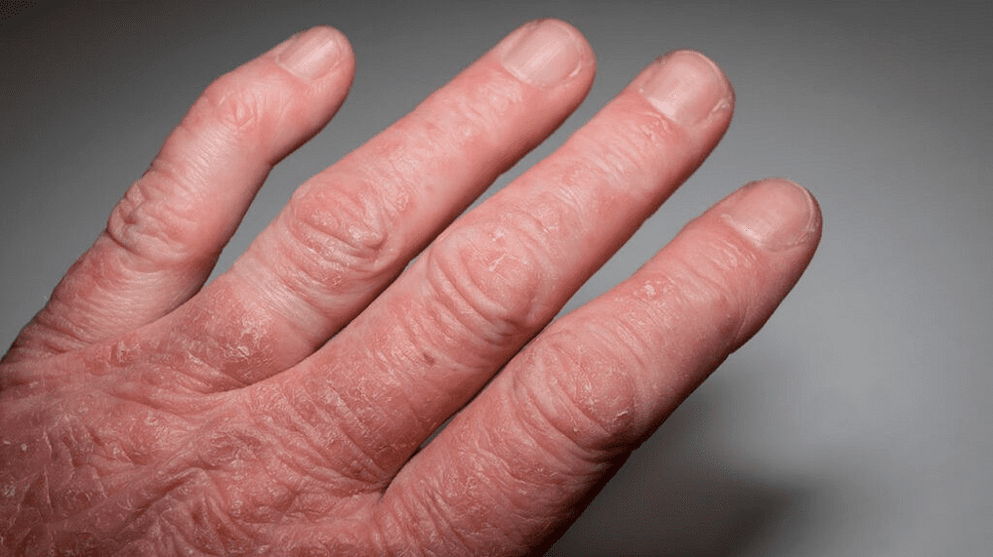psoriaticus ízületi gyulladás a kezeken