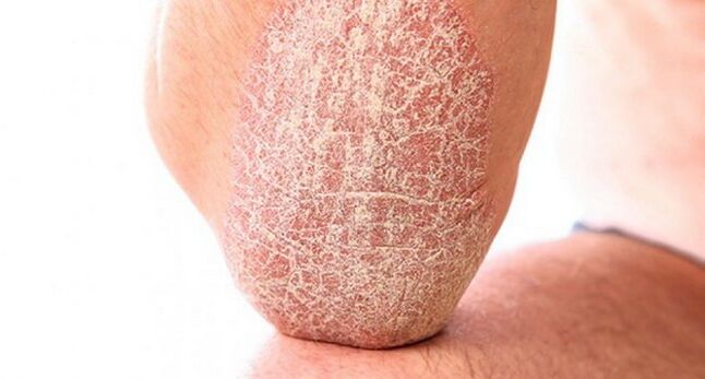 psoriasis vulgaris a bőrön