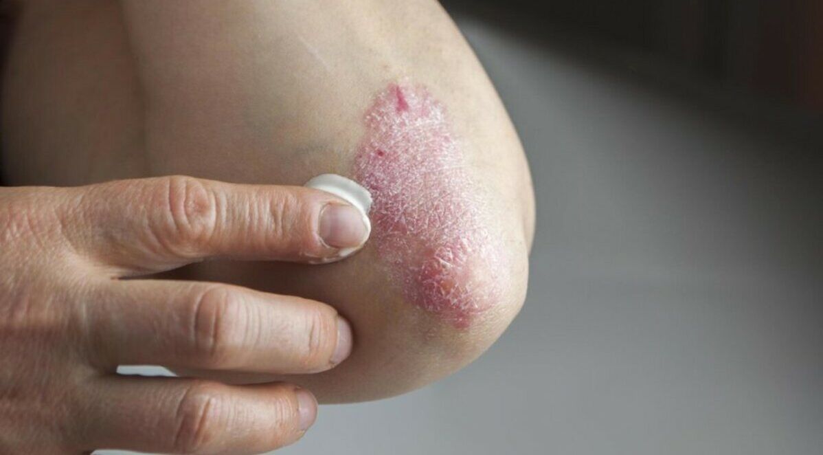 A bőrt érintő pikkelysömör, melynek kezelése kenőcsök alkalmazását foglalja magában