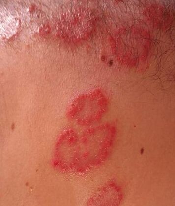 Psoriasis foltok