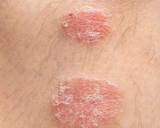 Psoriasis plakkok megjelenése