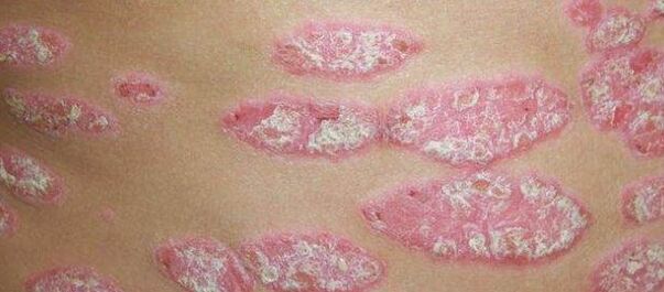 A psoriasis progresszív stádiuma