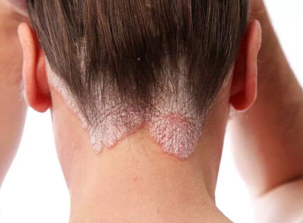Psoriatikus eritroderma