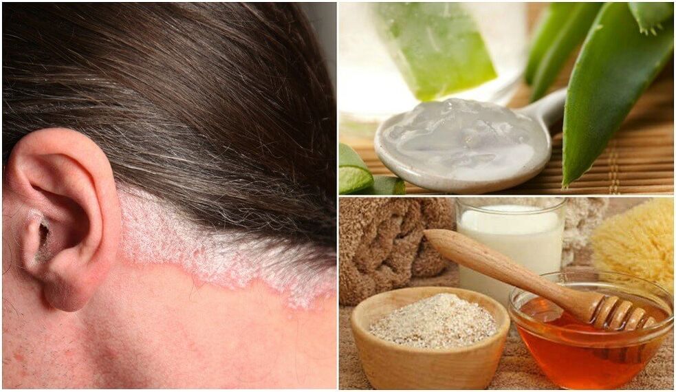 A psoriasis kezelése népi gyógyszerekkel