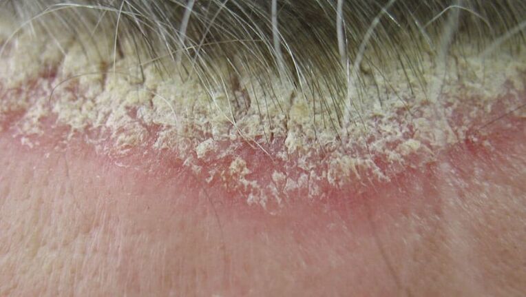 A fejbőr psoriasis