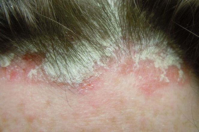 A psoriasis megragadja a fej teljes szőrös részét
