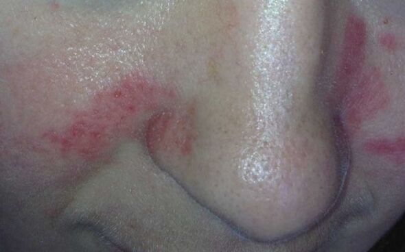 A psoriasis tünetei az arcon