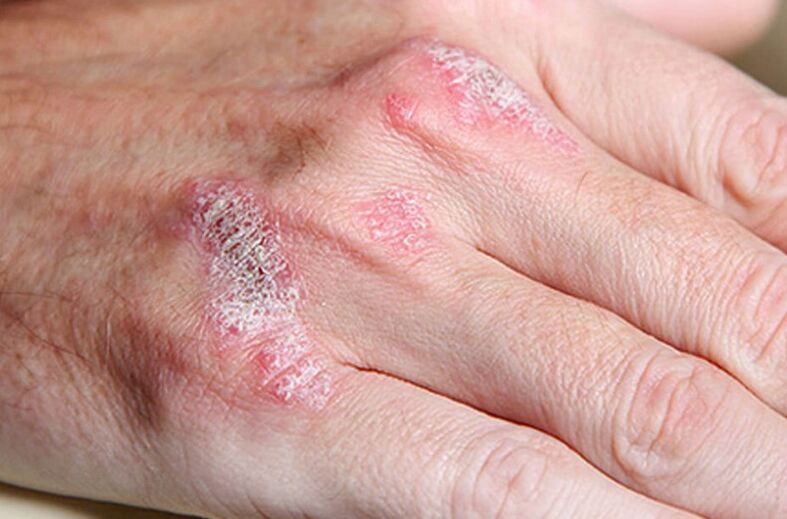 Hölgynövekedésű psoriasis