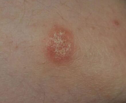 Psoriasis folt
