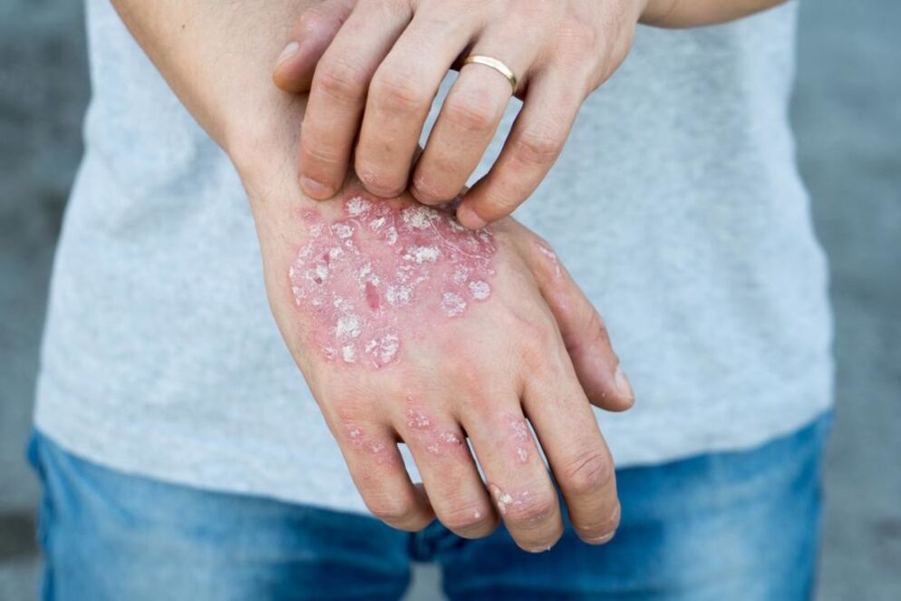 A psoriasis az