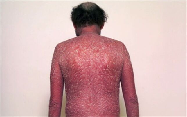 A psoriasis harmadik szakasza
