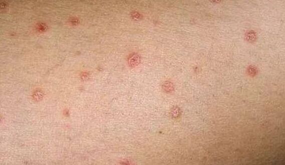 A psoriasis kezdeti szakasza