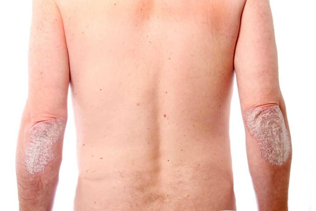 A psoriasis második szakasza
