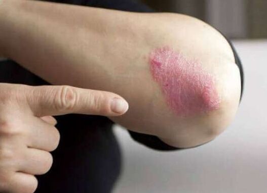 A psoriasis helyhez kötött stádiuma