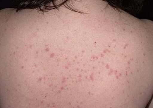 A psoriasis kezdeti szakasza
