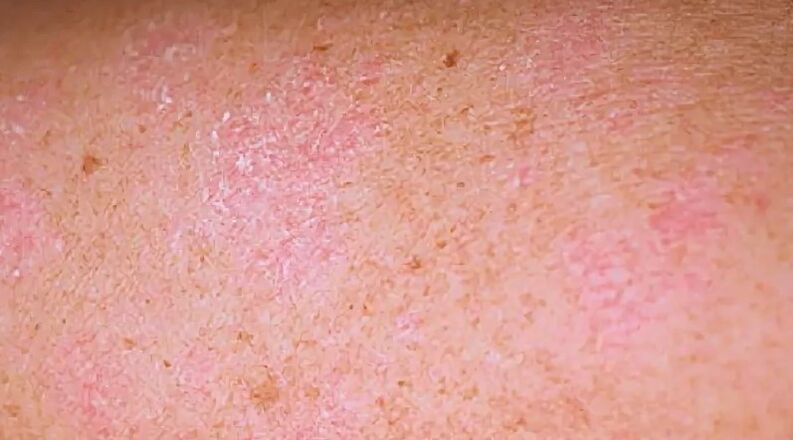 A psoriasis regresszív stádiuma