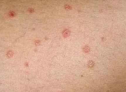 A kezdeti szakasz psoriasis