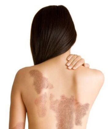 A psoriasis szakaszai a lézió területétől függően