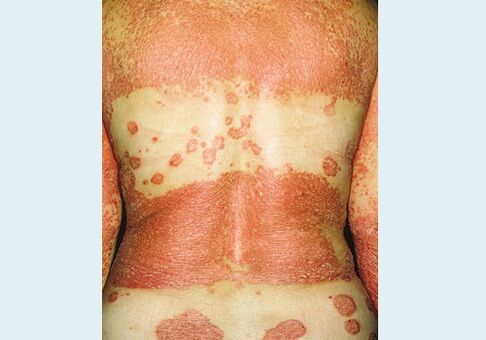 Nemi psoriasis