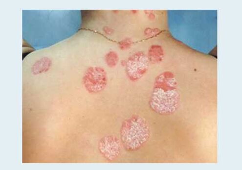 Rendes psoriasis