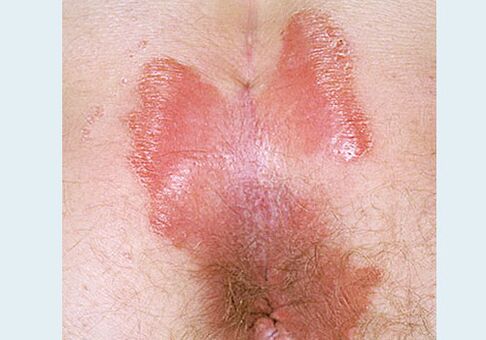 Záró psoriasis bezárása
