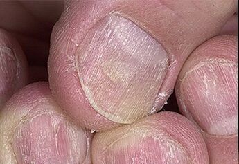 A körmök psoriasis