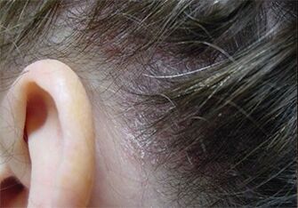 Psoriasis a fején