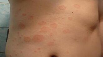 Psoriasis a gyomorban