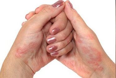 Psoriasis a kezekben