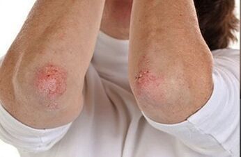 Psoriasis a könyökön