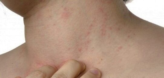 Psoriasis a nyakon