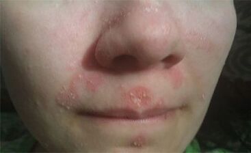 Psoriasis az arcon
