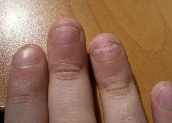 A körmök psoriasis