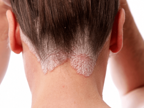 Psoriasis a fején