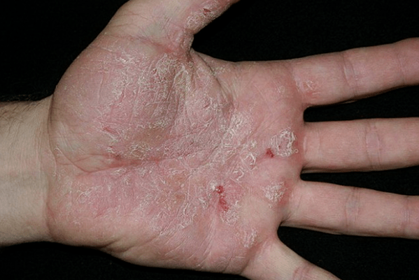 Psoriasis a kezekben