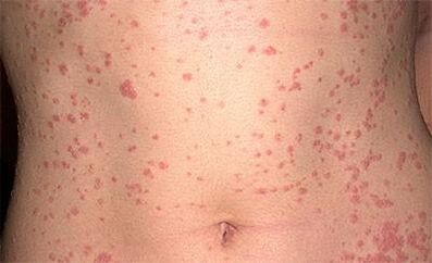 Psoriasis a testen