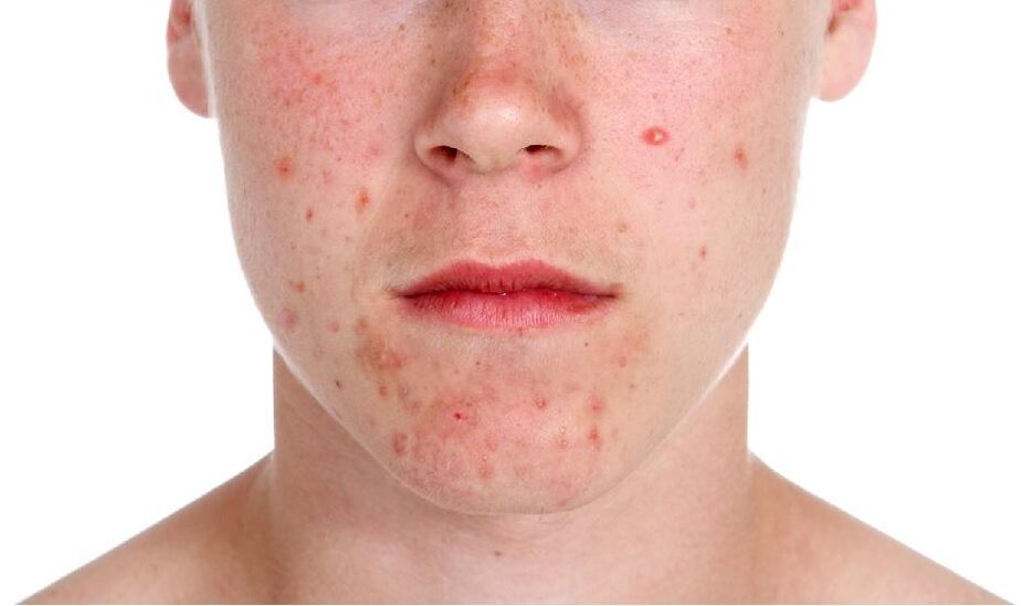 Psoriasis az arcon
