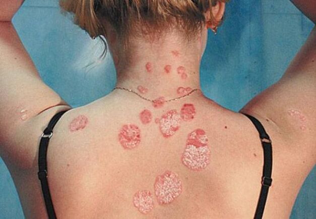 Psoriasis a hátán