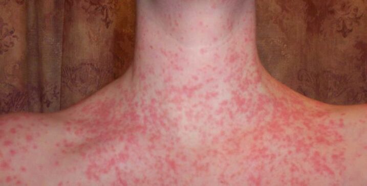 Psoriasis a testen