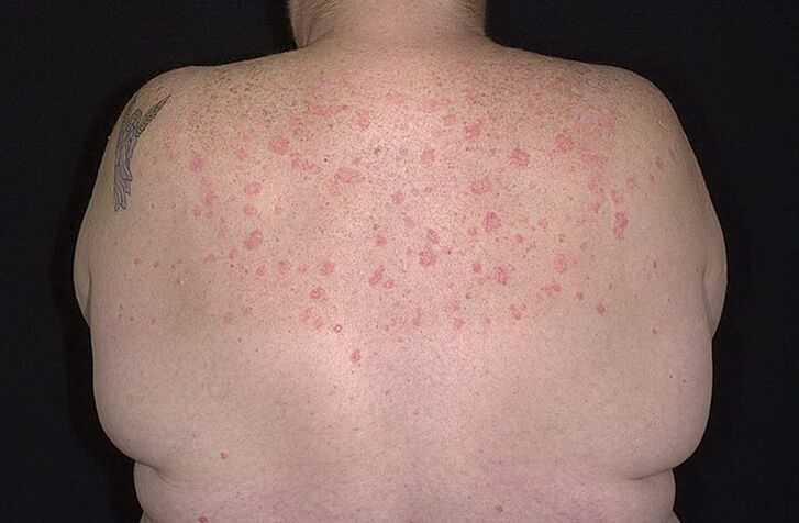 Psoriasis a vállakon