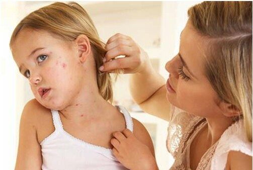 Fotó a psoriasis kezdeti szakaszáról