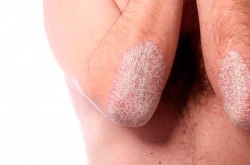 Psoriasis a könyökön