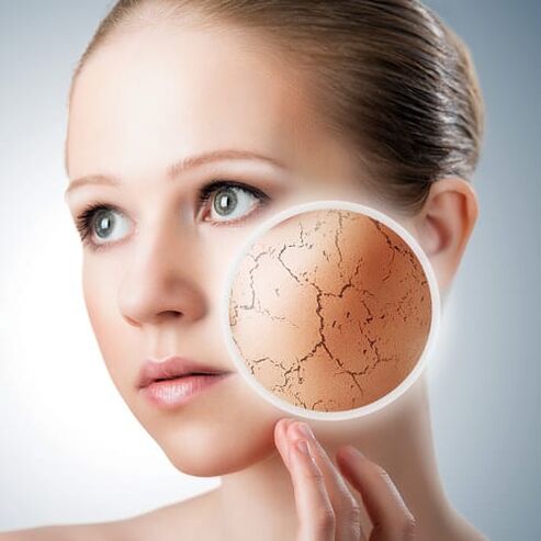 Psoriasis az arcon