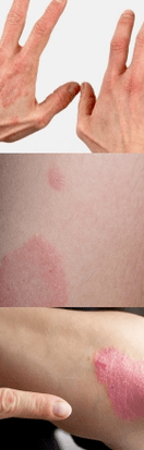 A kezén lévő kezdeti szakasz psoriasis