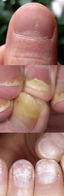 Köröm psoriasis - Kezdeti szakasz