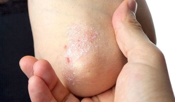 a psoriasis tünetei a kezdeti szakaszban