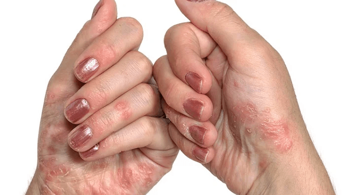 A psoriasis kezdeti szakasza